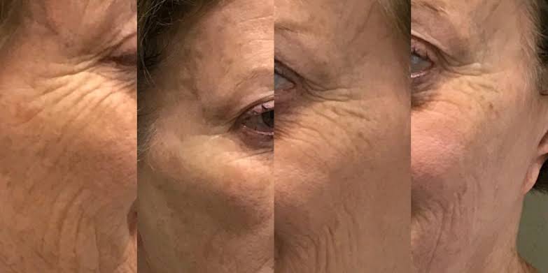 THE RADIANCE FACIAL, THE DELUXE FACIAL, THE AGE REWIND FACIAL, MICRODERMABRASION, CHEMICAL PEEL + LED LIGHT THERAPY