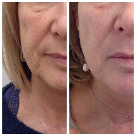 THE RADIANCE FACIAL, THE DELUXE FACIAL, THE AGE REWIND FACIAL, MICRODERMABRASION, CHEMICAL PEEL + LED LIGHT THERAPY