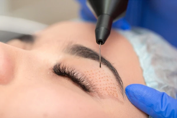 PLASMA TREATMENT