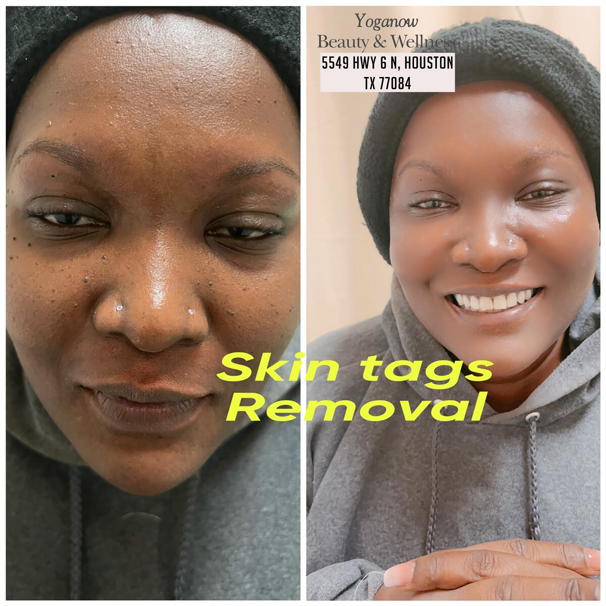 Skin care