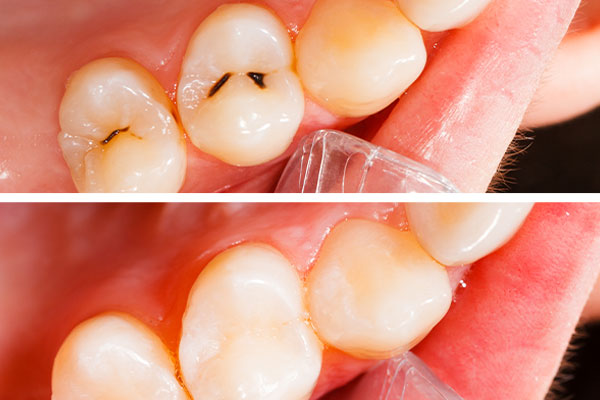 Dental Exam