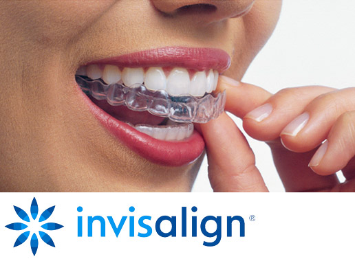 Clear Aligners