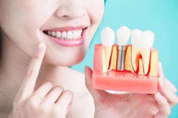 Clear Aligners