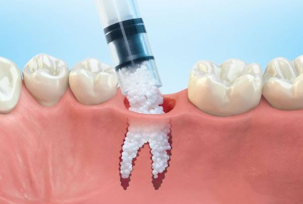 Clear Aligners