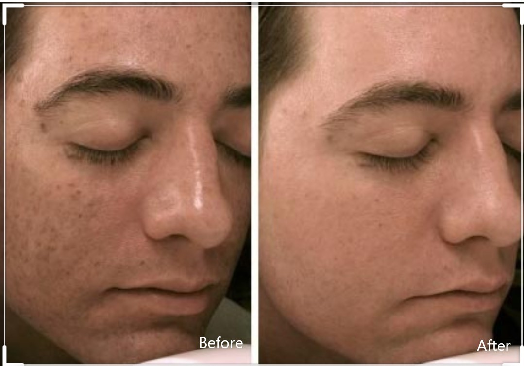 Micro-Needling